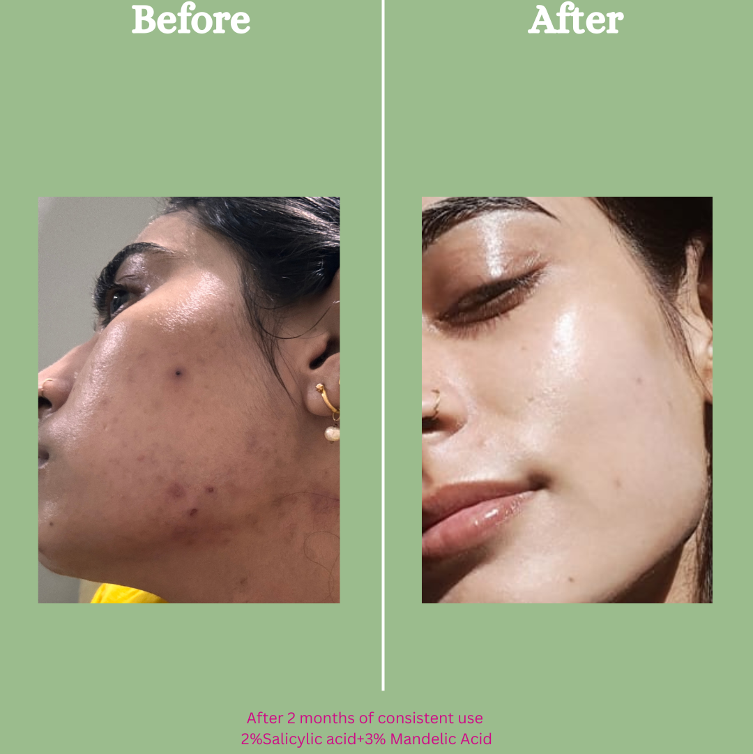 Salicylic Acid Serum